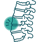 Spondylitis